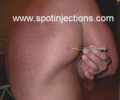 How to inject steroids in glute